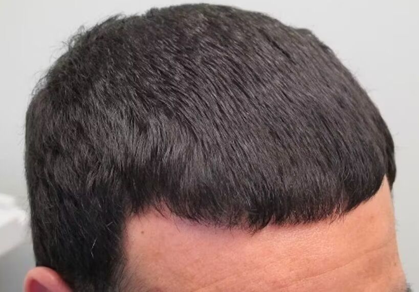 Curé la pérdida de cabello Verdoxidil