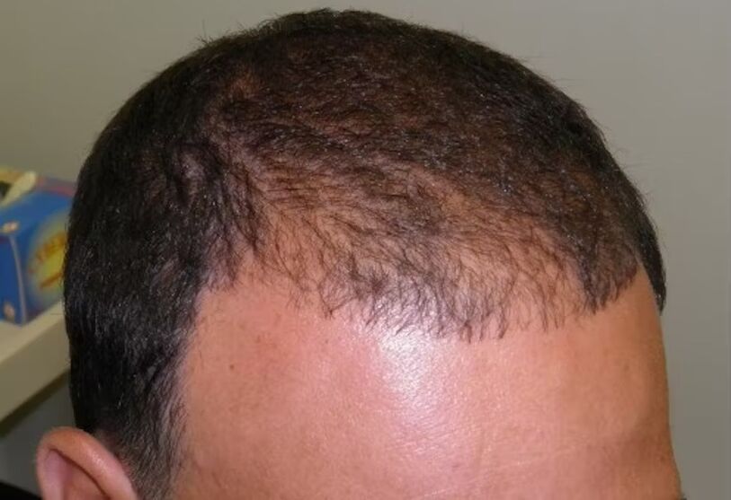 pérdida de cabello antes de usar verdoxidil
